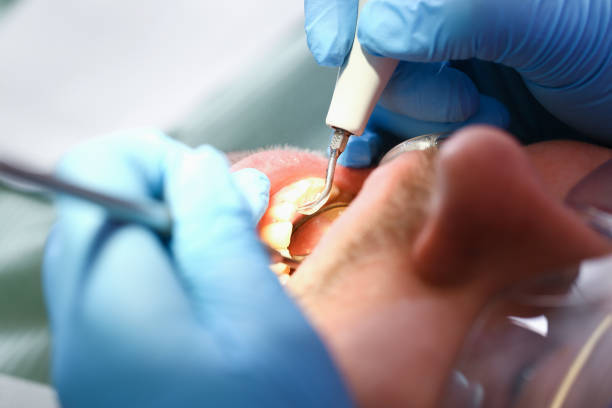 Best Emergency Broken Tooth Repair in Huntgton, IN